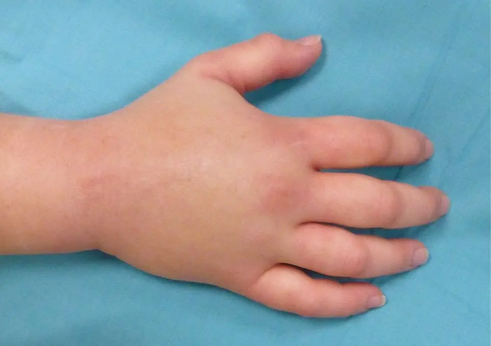 Figura 6. Angioedema hereditario, que afecta de forma importante a una mano