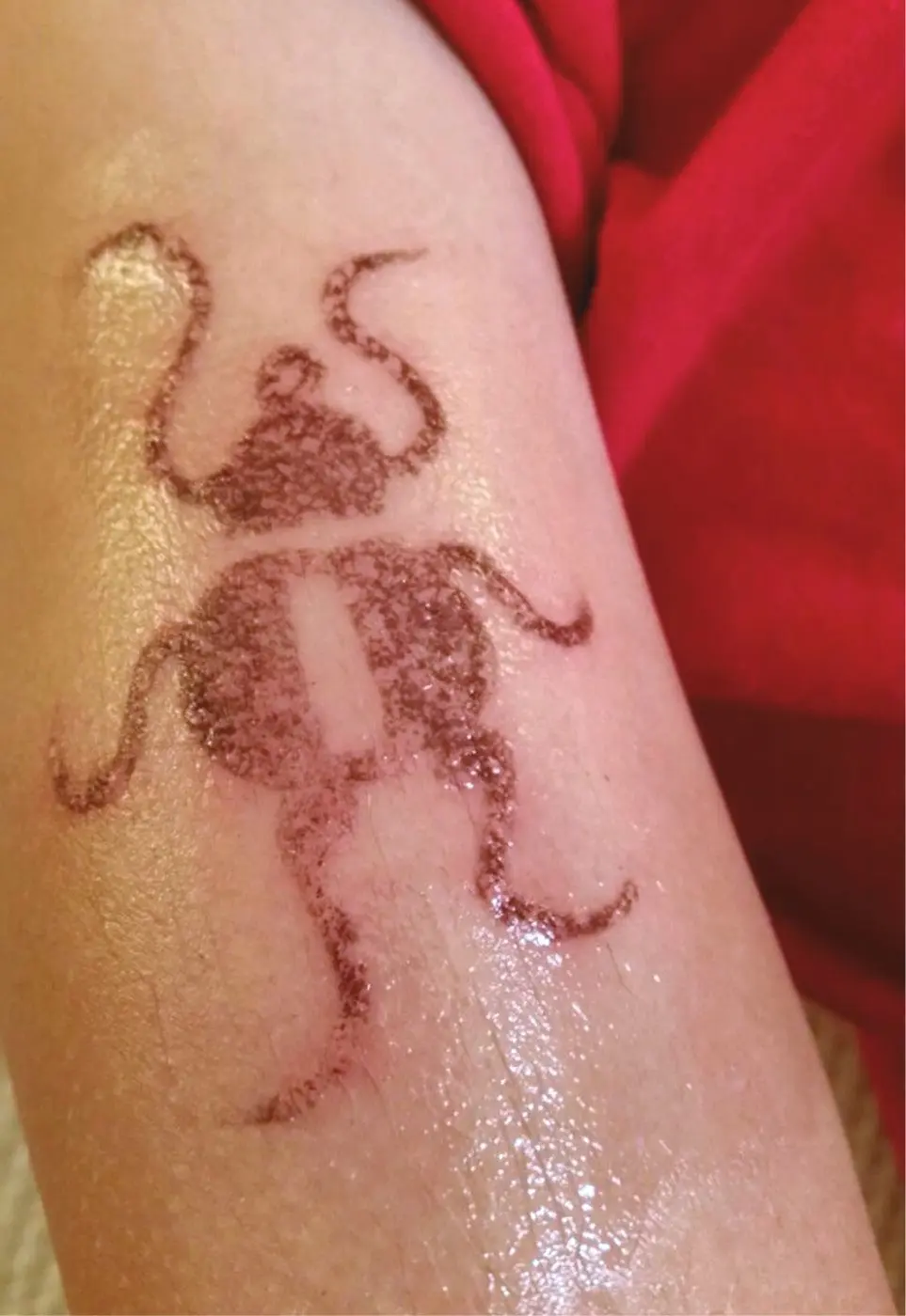 Figura 3. Dermatitis de contacto por tatuaje temporal (“henna negra”)