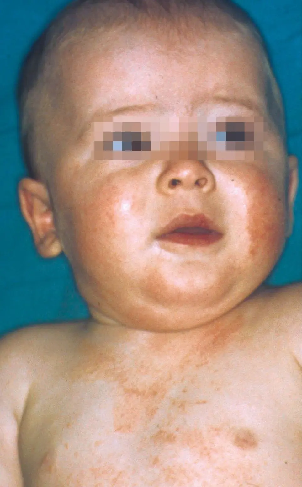 Figura 2. Dermatitis atópica en fase del lactante