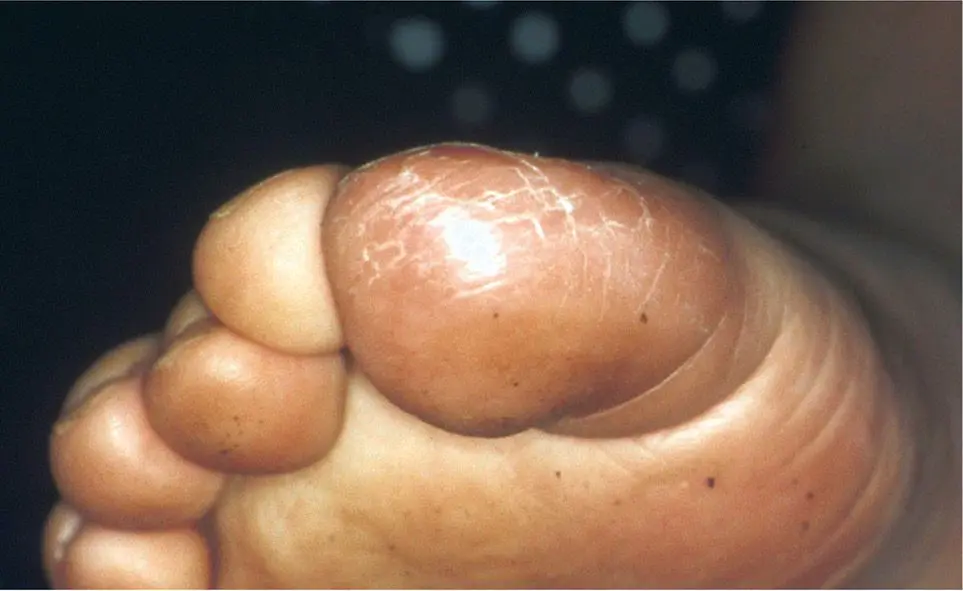 Figura 4. Dermatitis plantar juvenil