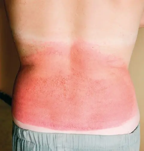 Caso grave de reacción fotoalérgica, causado por la aplicación de una loción analgésica en la parte inferior de la espalda y posterior exposición al sol.