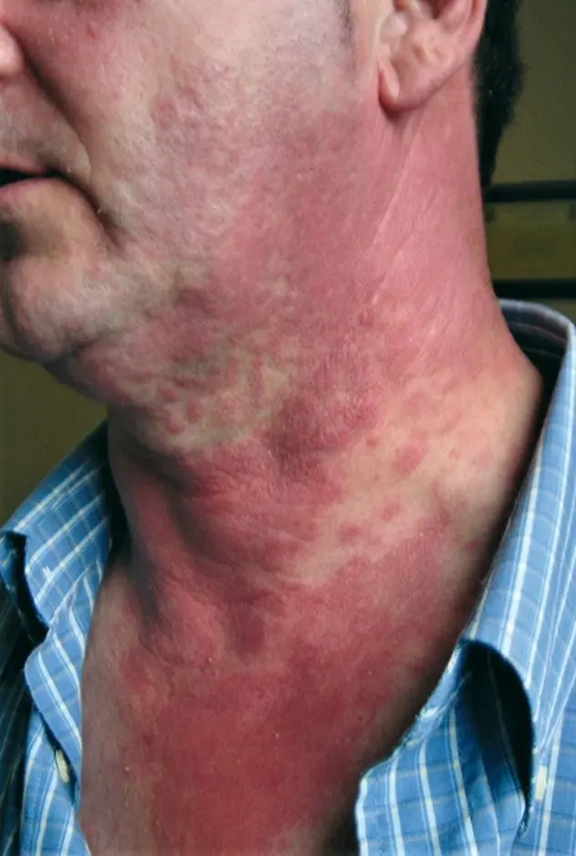Figura 2. Dermatitis fotoalérgica por piroxicam