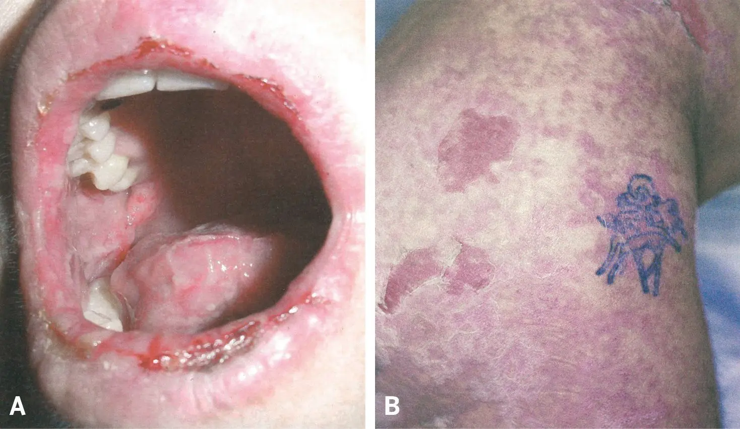 Figura 3. A) Síndrome de Stevens-Johnson por fenitoína. B) Necrólisis epidérmica tóxica por carbamazepina.