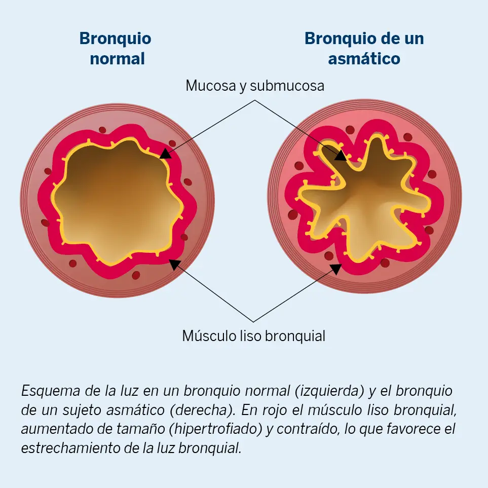 Figura 1. Bronquio normal y bronquio de un sujeto asmático.